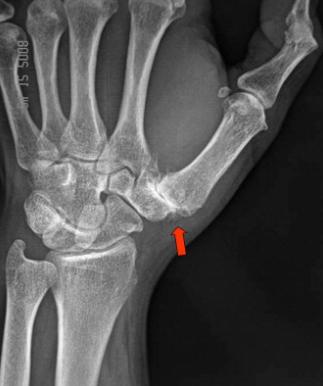 Thumb Arthritis