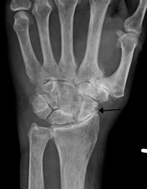 Wrist Arthritis