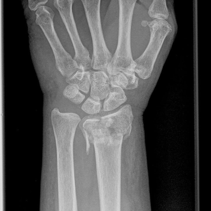 Distal radius fractures