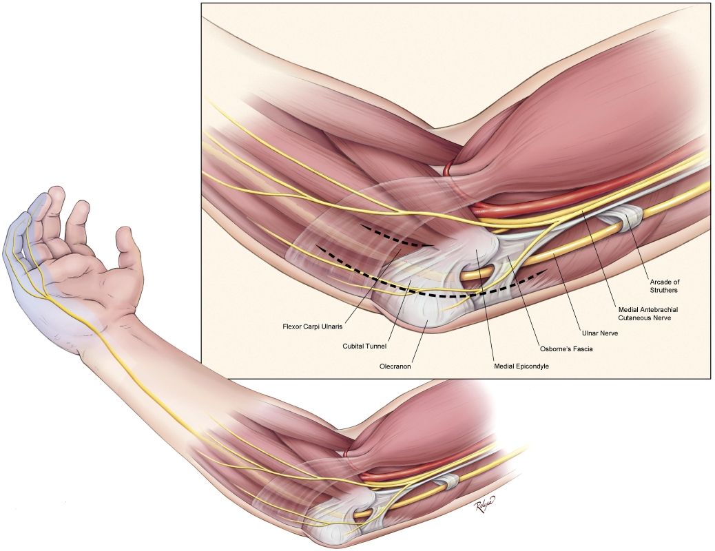 Cubital Tunnel Syndrome