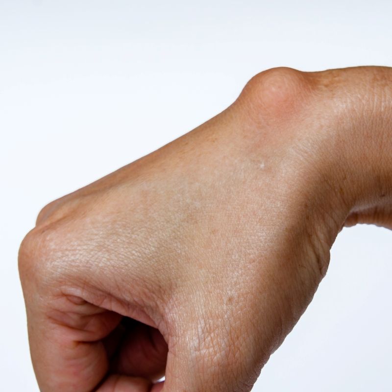Ganglion Cysts