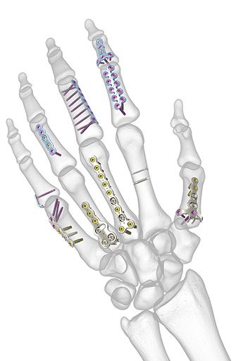 Hand Fractures